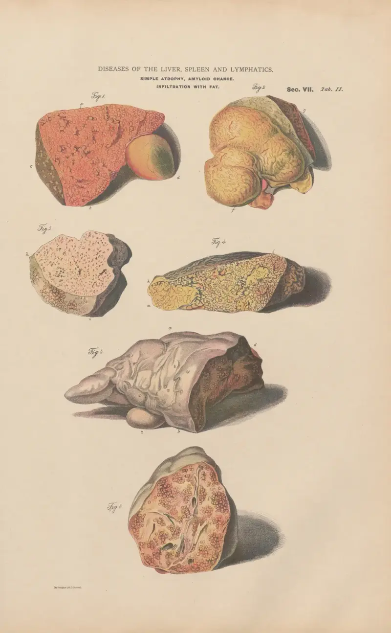Rote Atrophie der Leber, indurative Hypertrophie, 1888 von Jean Allard Jeancon