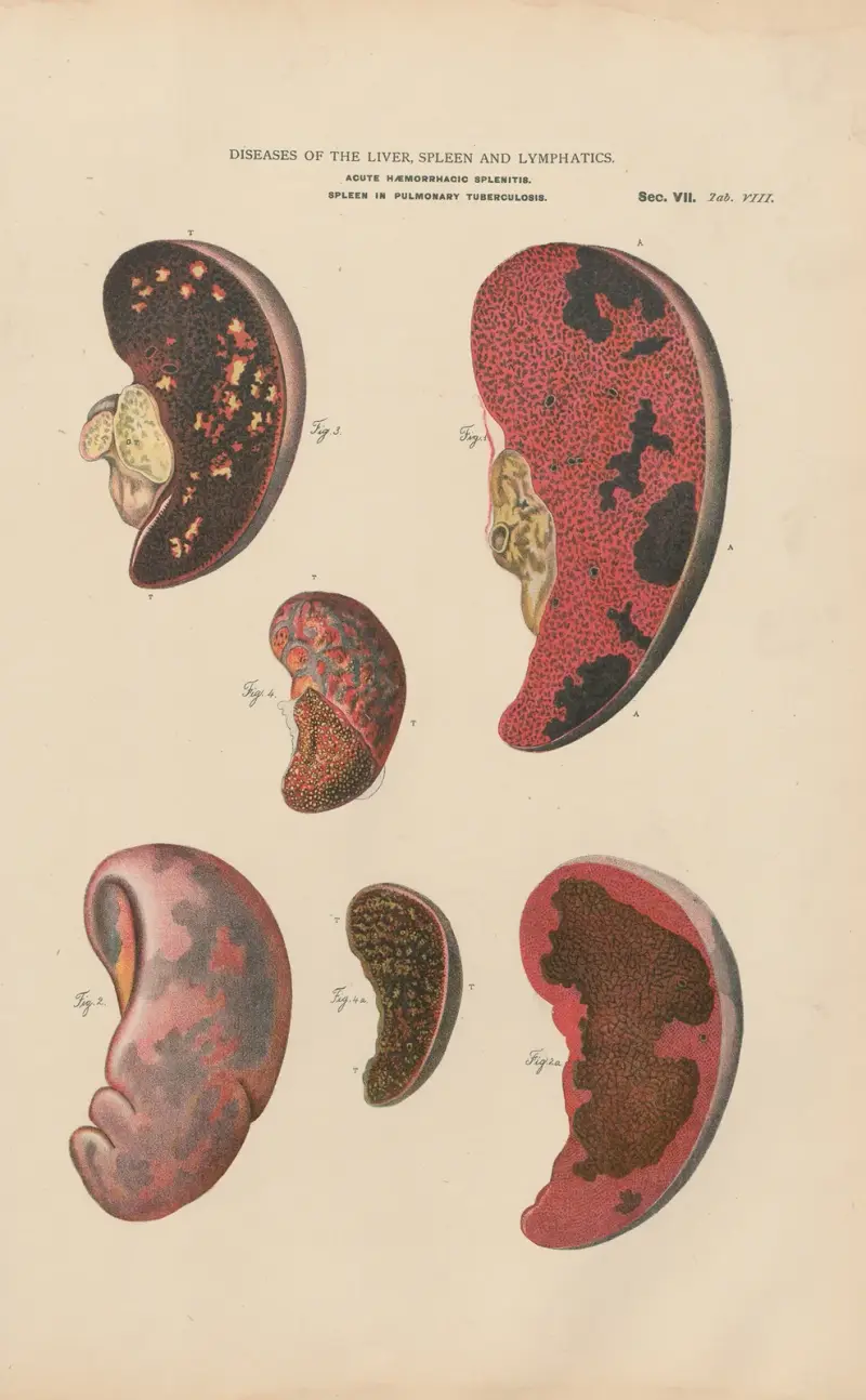 Milzentzündung und Infarkt, mit Abszessen von Jean Allard Jeancon