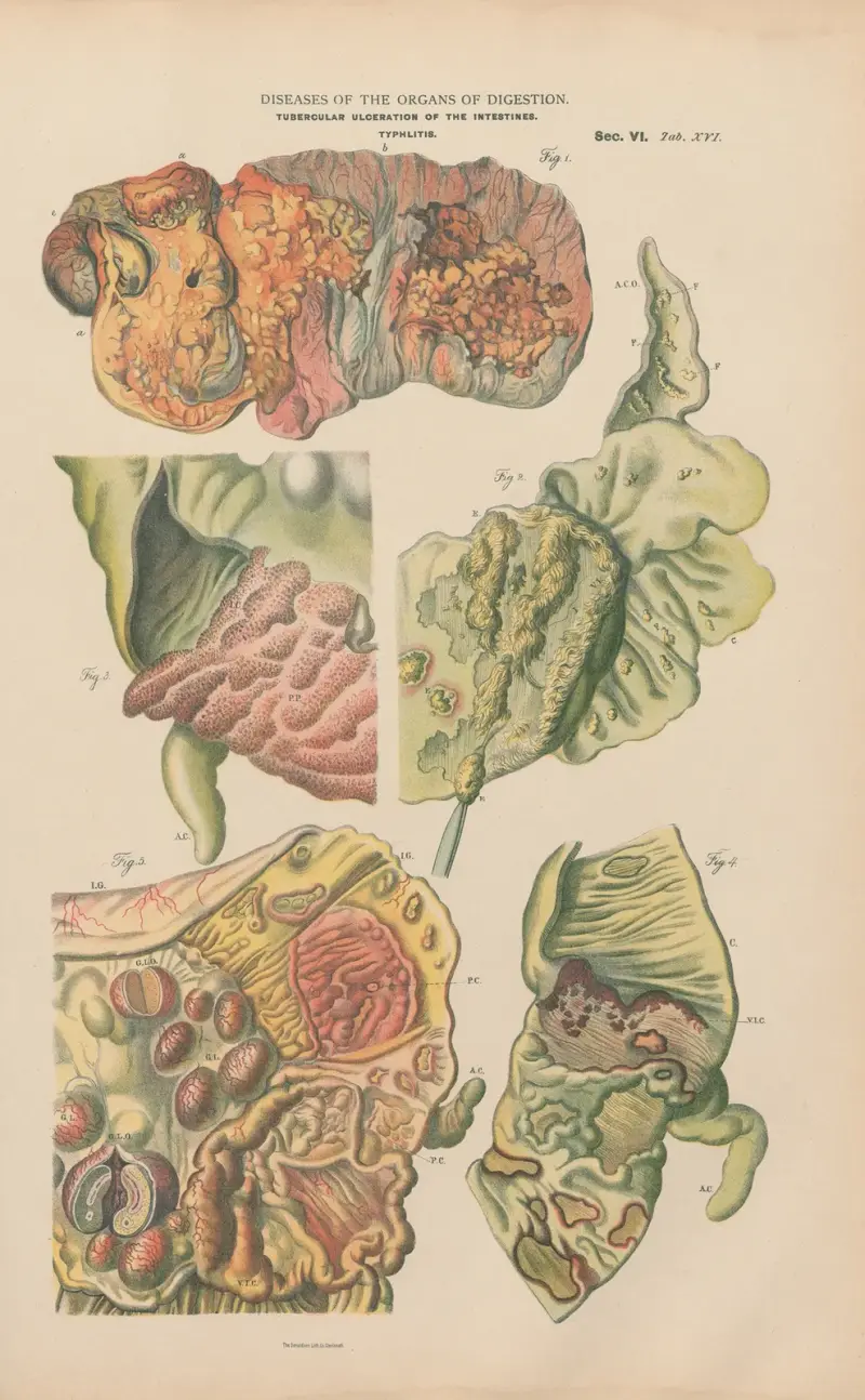 Tubercular ulceration of the intestines av Jean Allard Jeancon