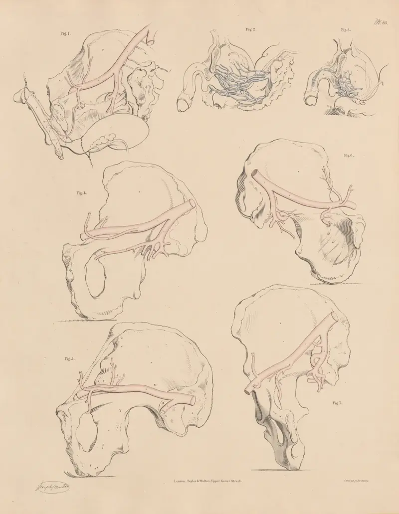 Eine Besonderheit eines der Schamzweige, erweiterte Venen der Prostata und Harnblase von Joseph Maclise