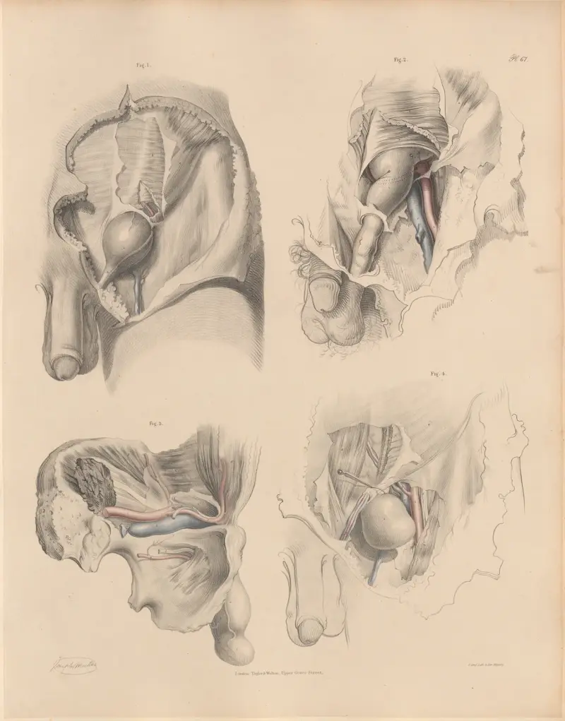 Epigastriska artärens läge i förhållande till olika typer av bråck av Joseph Maclise