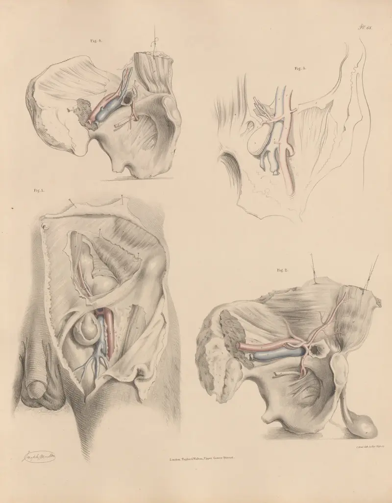Die verschiedenen Beziehungen der Obturatorarterie zu verschiedenen Hernienarten von Joseph Maclise