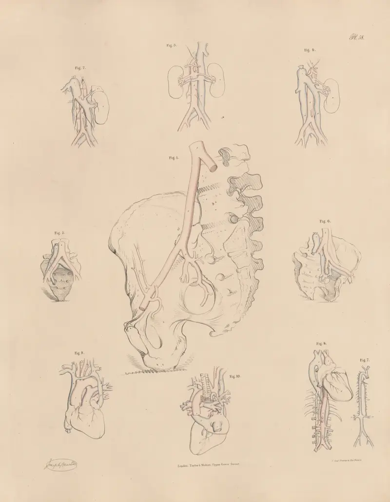 Ovanlig form på höftartärerna av Joseph Maclise