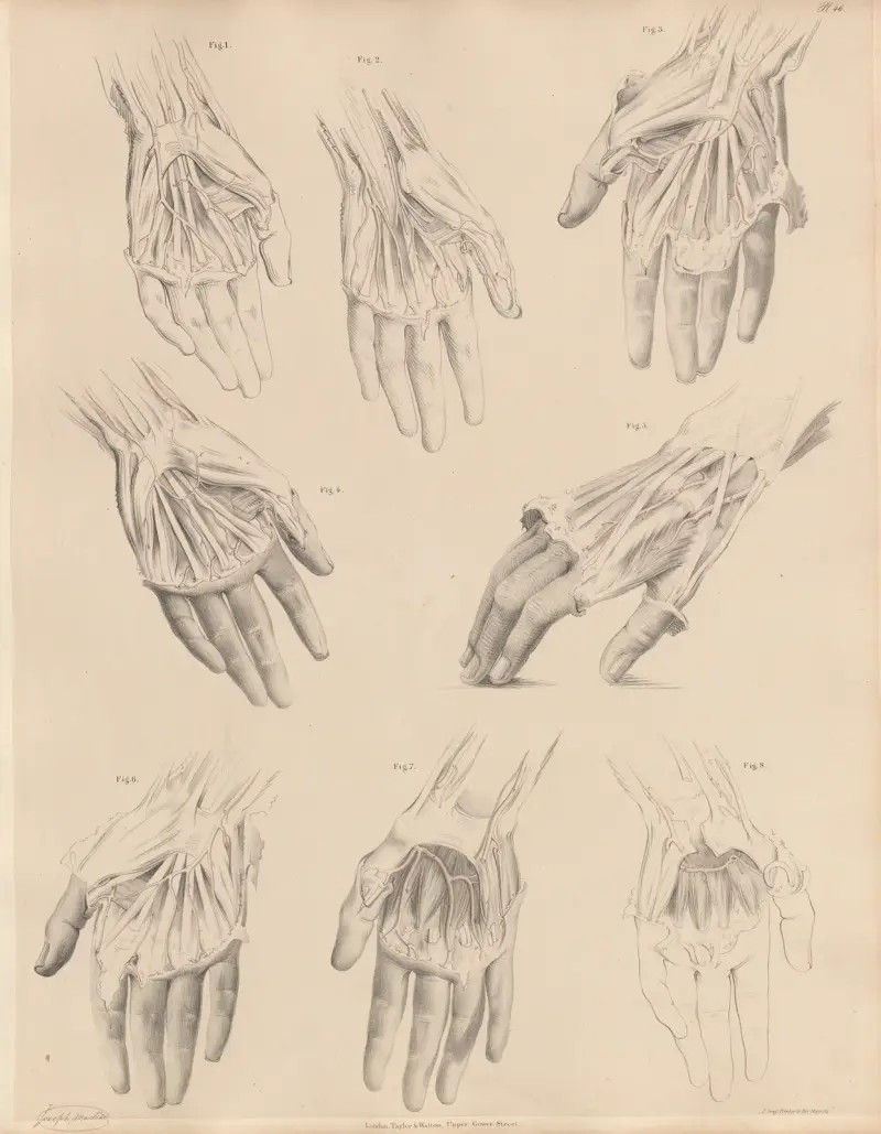 Olika tillstånd hos handens artärer av Joseph Maclise