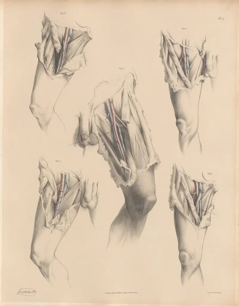 Verschiedene Formen der mit der Femoralarterie verbundenen Venen von Joseph Maclise